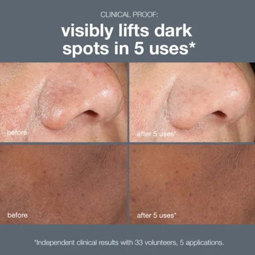 dark spot peel, visibly lifts dark spots in 5 uses